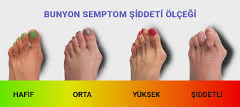 Ayakkabı seçerken dikkat: Parmağınızın anatomisi bozulabilir! Özellikle kadınlarda görülüyor